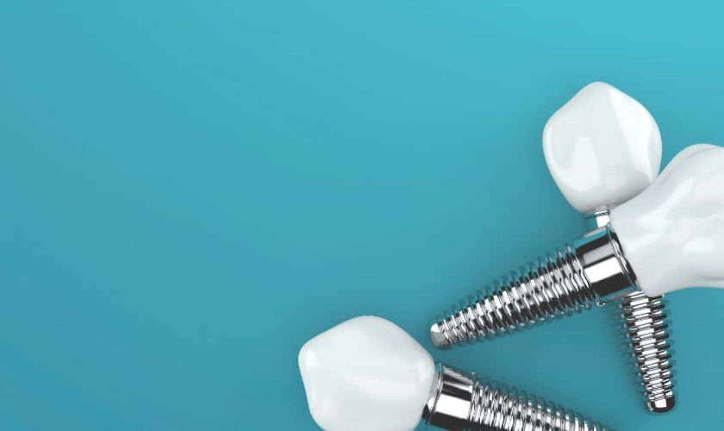 Dental Implants in North Richland Hills -Woodland Hills Dental